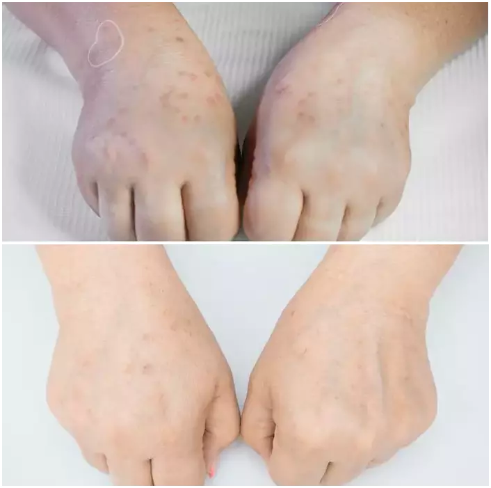 Rejuvenation with PlasmaPen.